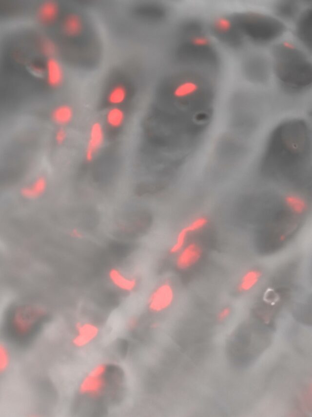 In Search of a New MRI Biomarker of Post-Traumatic Osteoarthritis